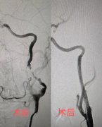 女子反复头痛竟是“脑中炸弹”作祟！医生紧急“拆弹”化险为夷